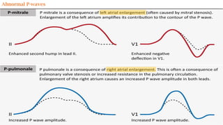 Abnormal P-waves
 
