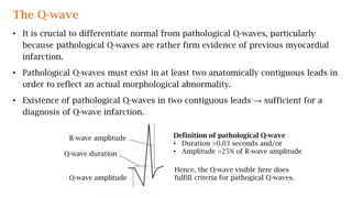 The Q-wave
• It is crucial to differentiate normal from pathological Q-waves, particularly
because pathological Q-waves are rather firm evidence of previous myocardial
infarction.
• Pathological Q-waves must exist in at least two anatomically contiguous leads in
order to reflect an actual morphological abnormality.
• Existence of pathological Q-waves in two contiguous leads → sufficient for a
diagnosis of Q-wave infarction.
R-wave amplitude
Q-wave duration
Q-wave amplitude
Definition of pathological Q-wave
• Duration >0.03 seconds and/or
• Amplitude >25% of R-wave amplitude
Hence, the Q-wave visible here does
fulfill criteria for pathogical Q-waves.
 