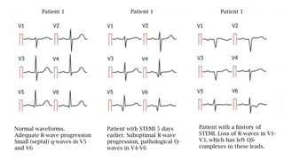 Normal waveforms.
Adequate R-wave progression
Small (septal) q-waves in V5
and V6
Patient with STEMI 5 days
earlier. Suboptimal R-wave
progression, pathological Q-
waves in V4-V6
Patient with a history of
STEMI. Loss of R-waves in V1-
V3, which has left QS-
complexes in these leads.
Patient 1 Patient 1 Patient 1
 