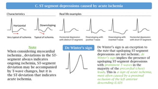 C. ST-segment depressions caused by acute ischemia
Note
When considering myocardial
ischemia , deviations in the ST-
segment always indicates
ongoing ischemia, ST-segment
deviation may be accompanied
by T-wave changes, but it is
the ST-deviation that indicates
acute ischemia.
De Winter’s sign De Winter’s sign is an exception to
the rute that upsloping ST-segment
depressions are not ischemic. de
Winter’s sign implies the presence of
upsloping ST-segment depressions
with prominent T-waves in the
majority of the precordial (chest)
leads. This is a sign of acute ischemia,
most often caused by a proximal
occlusion of the left anterior
descending (LAD)
 