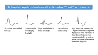 D. Secondary repolarization abnormalities (secondary ST- and T-wave changes)
 