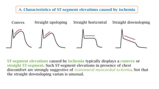 A. Characteristics of ST-segment elevations caused by ischemia
ST-segment elevations caused by ischemia typically displays a comvex or
straight ST-segment. Such ST-segment elevations in presence of chest
discomfort are strongly suggestive of transmural myocardial ischemia. Not that
the straight downsloping varian is unusual.
Convex Straight upsloping Straight horizontal Straight downsloping
 