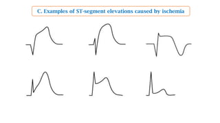 C. Examples of ST-segment elevations caused by ischemia
 