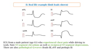 D. Real life example (limb leads shown)
ECG from a male patient (age 61) who experienced chest pain while driving to
work. Note ST-segment elevations as well as reciprocal ST-segment depressions.
There are also pathological Q-waves (leads III, aVF and perhaps II)
 