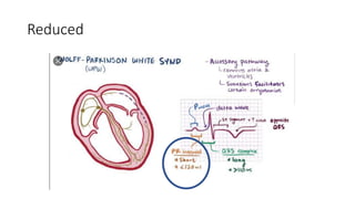 Ecg interpretation