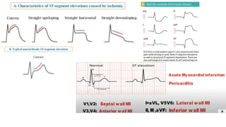 Ecg interpretation
