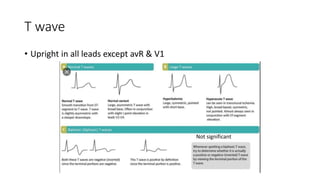 Ecg interpretation