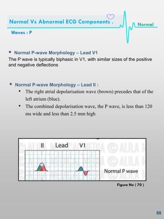  Normal P-wave Morphology – Lead II :
• The right atrial depolarisation wave (brown) precedes that of the
left atrium (blue).
• The combined depolarisation wave, the P wave, is less than 120
ms wide and less than 2.5 mm high
 Normal P-wave Morphology – Lead V1
The P wave is typically biphasic in V1, with similar sizes of the positive
and negative deflections
Waves : P
Normal Vs Abnormal ECG Components . Normal
Figure No ( 70 )
 