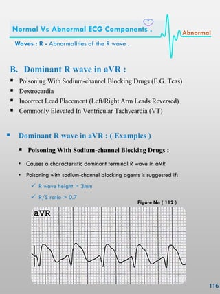 B. Dominant R wave in aVR :
 Poisoning With Sodium-channel Blocking Drugs (E.G. Tcas)
 Dextrocardia
 Incorrect Lead Placement (Left/Right Arm Leads Reversed)
 Commonly Elevated In Ventricular Tachycardia (VT)
 Dominant R wave in aVR : ( Examples )
 Poisoning With Sodium-channel Blocking Drugs :
• Causes a characteristic dominant terminal R wave in aVR
• Poisoning with sodium-channel blocking agents is suggested if:
 R wave height > 3mm
 R/S ratio > 0.7
Waves : R - Abnormalities of the R wave .
Normal Vs Abnormal ECG Components . Abnormal
Figure No ( 112 )
 
