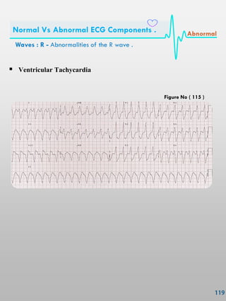  Ventricular Tachycardia
Waves : R - Abnormalities of the R wave .
Normal Vs Abnormal ECG Components . Abnormal
Figure No ( 115 )
 