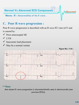 C. Poor R wave progression :
Poor R wave progression is described with an R wave ≤ 3 mm inV3 and
is caused by:
 Prior anteroseptal MI
 LVH
 Inaccurate lead placement
 May be a normal variant
***Note
that absent R wave progression is characteristically seen in dextrocardia (see
previous ECGs).
Waves : R - Abnormalities of the R wave .
Normal Vs Abnormal ECG Components . Abnormal
Figure No ( 116 )
 
