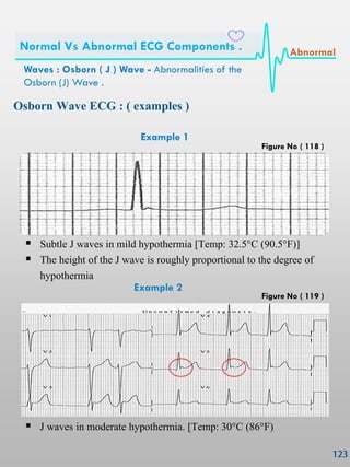 Osborn Wave ECG : ( examples )
Example 1
 Subtle J waves in mild hypothermia [Temp: 32.5°C (90.5°F)]
 The height of the J wave is roughly proportional to the degree of
hypothermia
Example 2
 J waves in moderate hypothermia. [Temp: 30°C (86°F)
Waves : Osborn ( J ) Wave - Abnormalities of the
Osborn (J) Wave .
Normal Vs Abnormal ECG Components . Abnormal
Figure No ( 118 )
Figure No ( 119 )
 