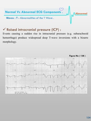 Raised intracranial pressure (ICP) :
Events causing a sudden rise in intracranial pressure (e.g. subarachnoid
hemorrhage) produce widespread deep T-wave inversions with a bizarre
morphology.
Waves : T - Abnormalities of the T Wave .
Normal Vs Abnormal ECG Components . Abnormal
Figure No ( 138 )
 