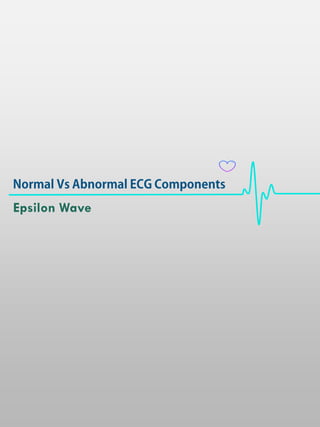 Epsilon Wave
 