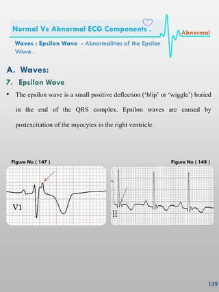 A. Waves:
7. Epsilon Wave
• The epsilon wave is a small positive deflection (―blip‖ or ―wiggle‖) buried
in the end of the QRS complex. Epsilon waves are caused by
postexcitation of the myocytes in the right ventricle.
Waves : Epsilon Wave - Abnormalities of the Epsilon
Wave .
Normal Vs Abnormal ECG Components . Abnormal
Figure No ( 147 ) Figure No ( 148 )
 