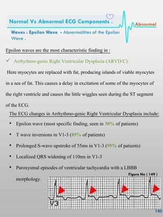 Epsilon waves are the most characteristic finding in :
 Arrhythmo-genic Right Ventricular Dysplasia (ARVD/C).
Here myocytes are replaced with fat, producing islands of viable myocytes
in a sea of fat. This causes a delay in excitation of some of the myocytes of
the right ventricle and causes the little wiggles seen during the ST segment
of the ECG.
The ECG changes in Arrhythmo-genic Right Ventricular Dysplasia include:
• Epsilon wave (most specific finding, seen in 30% of patients)
• T wave inversions in V1-3 (85% of patients)
• Prolonged S-wave upstroke of 55ms in V1-3 (95% of patients)
• Localized QRS widening of 110ms in V1-3
• Paroxysmal episodes of ventricular tachycardia with a LBBB
morphology.
Waves : Epsilon Wave - Abnormalities of the Epsilon
Wave .
Normal Vs Abnormal ECG Components . Abnormal
Figure No ( 149 )
 