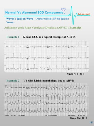Example 1 12-lead ECG is a typical example of ARVD.
Arrhythmo-genic Right Ventricular Dysplasia (ARVD) : Examples
Example 2 VT with LBBB morphology due to ARVD
Waves : Epsilon Wave - Abnormalities of the Epsilon
Wave .
Normal Vs Abnormal ECG Components . Abnormal
Figure No ( 150 )
Figure No ( 151 )
 