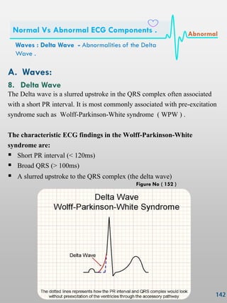 A. Waves:
8. Delta Wave
The Delta wave is a slurred upstroke in the QRS complex often associated
with a short PR interval. It is most commonly associated with pre-excitation
syndrome such as Wolff-Parkinson-White syndrome ( WPW ) .
The characteristic ECG findings in the Wolff-Parkinson-White
syndrome are:
 Short PR interval (< 120ms)
 Broad QRS (> 100ms)
 A slurred upstroke to the QRS complex (the delta wave)
Waves : Delta Wave - Abnormalities of the Delta
Wave .
Normal Vs Abnormal ECG Components . Abnormal
Figure No ( 152 )
 