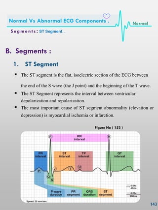 B. Segments :
1. ST Segment
 The ST segment is the flat, isoelectric section of the ECG between
the end of the S wave (the J point) and the beginning of the T wave.
 The ST Segment represents the interval between ventricular
depolarization and repolarization.
 The most important cause of ST segment abnormality (elevation or
depression) is myocardial ischemia or infarction.
S e gmen ts : ST Segment .
Normal Vs Abnormal ECG Components . Normal
Figure No ( 153 )
 