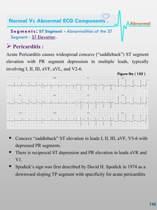  Pericarditis :
Acute Pericarditis causes widespread concave (‗saddleback‘) ST segment
elevation with PR segment depression in multiple leads, typically
involving I, II, III, aVF, aVL, and V2-6.
 Concave ‗saddleback‘ ST elevation in leads I, II, III, aVF, V5-6 with
depressed PR segments.
 There is reciprocal ST depression and PR elevation in leads aVR and
V1.
 Spodick‖s sign was first described by David H. Spodick in 1974 as a
downward sloping TP segment with specificity for acute pericarditis
S e gmen ts : ST Segment - Abnormalities of the ST
Segment - ST Elevation .
Normal Vs Abnormal ECG Components . Abnormal
Figure No ( 155 )
 