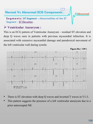  Ventricular Aneurysm :
This is an ECG pattern of Ventricular Aneurysm – residual ST elevation and
deep Q waves seen in patients with previous myocardial infarction. It is
associated with extensive myocardial damage and paradoxical movement of
the left ventricular wall during systole.
• There is ST elevation with deep Q waves and inverted T waves in V1-3.
• This pattern suggests the presence of a left ventricular aneurysm due to a
prior anteroseptal MI.
S e gmen ts : ST Segment - Abnormalities of the ST
Segment - ST Elevation .
Normal Vs Abnormal ECG Components . Abnormal
Figure No ( 159 )
 