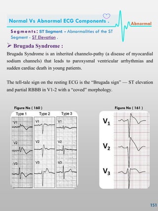  Brugada Syndrome :
Brugada Syndrome is an inherited channelo-pathy (a disease of myocardial
sodium channels) that leads to paroxysmal ventricular arrhythmias and
sudden cardiac death in young patients.
The tell-tale sign on the resting ECG is the ‗Brugada sign‘ — ST elevation
and partial RBBB in V1-2 with a ‗coved‘ morphology.
S e gmen ts : ST Segment - Abnormalities of the ST
Segment - ST Elevation .
Normal Vs Abnormal ECG Components . Abnormal
Figure No ( 160 ) Figure No ( 161 )
 