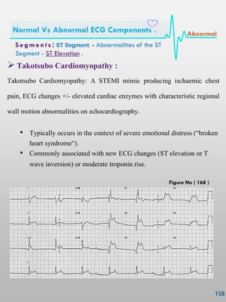  Takotsubo Cardiomyopathy :
Takotsubo Cardiomyopathy: A STEMI mimic producing ischaemic chest
pain, ECG changes +/- elevated cardiac enzymes with characteristic regional
wall motion abnormalities on echocardiography.
• Typically occurs in the context of severe emotional distress (‗broken
heart syndrome‗).
• Commonly associated with new ECG changes (ST elevation or T
wave inversion) or moderate troponin rise.
S e gmen ts : ST Segment - Abnormalities of the ST
Segment - ST Elevation .
Normal Vs Abnormal ECG Components . Abnormal
Figure No ( 168 )
 