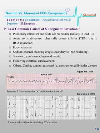  Less Common Causes of ST segment Elevation :
o Pulmonary embolism and acute cor pulmonale (usually in lead III)
o Acute aortic dissection (classically causes inferior STEMI due to
RCA dissection)
o Hyperkalaemia
o Sodium-channel blocking drugs (secondary to QRS widening)
o J-waves (hypothermia, hypercalcaemia)
o Following electrical cardioversion
o Others: Cardiac tumour, myocarditis, pancreas or gallbladder disease
Transient ST elevation after DC cardioversion from VF .
J waves in hypothermia simulating ST elevation
S e gmen ts : ST Segment - Abnormalities of the ST
Segment - ST Elevation .
Normal Vs Abnormal ECG Components . Abnormal
Figure No ( 169 )
Figure No ( 170 )
 
