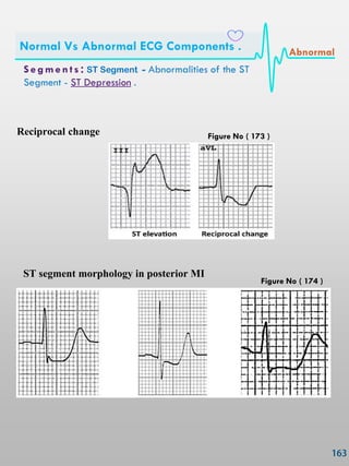 Reciprocal change
ST segment morphology in posterior MI
S e gmen ts : ST Segment - Abnormalities of the ST
Segment - ST Depression .
Normal Vs Abnormal ECG Components . Abnormal
Figure No ( 173 )
Figure No ( 174 )
 