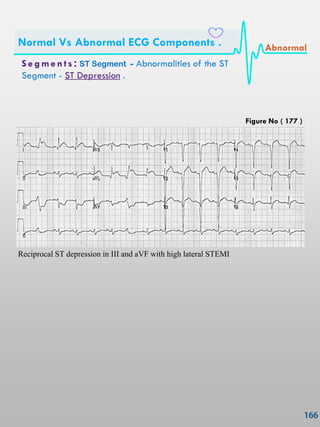 Reciprocal ST depression in III and aVF with high lateral STEMI
S e gmen ts : ST Segment - Abnormalities of the ST
Segment - ST Depression .
Normal Vs Abnormal ECG Components . Abnormal
Figure No ( 177 )
 