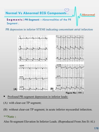 PR depression in inferior STEMI indicating concomitant atrial infarction
 Profound PR-segment depression in inferior leads:
(A) with clear-cut TP segment;
(B) without clear-cut TP segment; in acute inferior myocardial infarction.
(A) (B)
**Note :
Also St-segment Elevation In Inferior Leads. (Reproduced From Jim Et Al.)
S e gmen ts : PR Segment - Abnormalities of the PR
Segment .
Normal Vs Abnormal ECG Components . Abnormal
Figure No ( 191 )
 