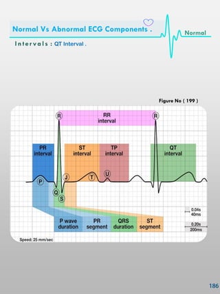 In ter vals : QT Interval .
Normal Vs Abnormal ECG Components . Normal
Figure No ( 199 )
 