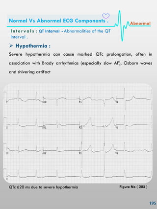  Hypothermia :
Severe hypothermia can cause marked QTc prolongation, often in
association with Brady arrhythmias (especially slow AF), Osborn waves
and shivering artifact
QTc 620 ms due to severe hypothermia
In ter vals : QT Interval - Abnormalities of the QT
Interval .
Normal Vs Abnormal ECG Components . Abnormal
Figure No ( 205 )
 