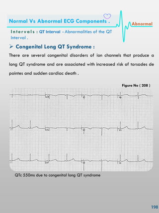  Congenital Long QT Syndrome :
There are several congenital disorders of ion channels that produce a
long QT syndrome and are associated with increased risk of torsades de
pointes and sudden cardiac death .
QTc 550ms due to congenital long QT syndrome
In ter vals : QT Interval - Abnormalities of the QT
Interval .
Normal Vs Abnormal ECG Components . Abnormal
Figure No ( 208 )
 