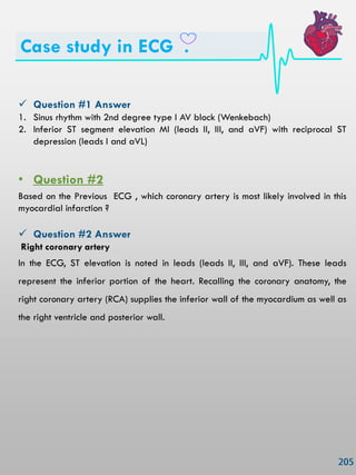 Case study in ECG .
 Question #1 Answer
1. Sinus rhythm with 2nd degree type I AV block (Wenkebach)
2. Inferior ST segment elevation MI (leads II, III, and aVF) with reciprocal ST
depression (leads I and aVL)
• Question #2
Based on the Previous ECG , which coronary artery is most likely involved in this
myocardial infarction ?
 Question #2 Answer
Right coronary artery
In the ECG, ST elevation is noted in leads (leads II, III, and aVF). These leads
represent the inferior portion of the heart. Recalling the coronary anatomy, the
right coronary artery (RCA) supplies the inferior wall of the myocardium as well as
the right ventricle and posterior wall.
 
