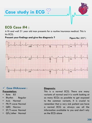 Case study in ECG .
ECG Case #4 :
A fit and well 31 year old man presents for a routine insurance medical. This is
his ECG.
Present your findings and give the diagnosis ?
 Case #4Answer :
Presentation:
• Rate 85
• Rhythm Regular
• Axis Normal
• PR/P-wave Normal
• QRS Narrow
• ST/T-wave Normal
• QTc/other Normal
Diagnosis:
This is a normal ECG. There are many
variants of normal and it is worth looking at
as many ECGs as possible to get exposed
to the common variants. It is crucial to
remember that a very sick patient can have
a normal ECG so always use all the
information available to you and don‘t rely
on the ECG alone
Figure No ( 217 )
 