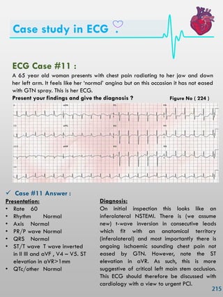 Case study in ECG .
ECG Case #11 :
A 65 year old woman presents with chest pain radiating to her jaw and down
her left arm. It feels like her ‗normal‘ angina but on this occasion it has not eased
with GTN spray. This is her ECG.
Present your findings and give the diagnosis ?
 Case #11 Answer :
Presentation:
• Rate 60
• Rhythm Normal
• Axis Normal
• PR/P wave Normal
• QRS Normal
• ST/T wave T wave inverted
in II III and aVF , V4 – V5. ST
elevation in aVR>1mm
• QTc/other Normal
Diagnosis:
On initial inspection this looks like an
inferolateral NSTEMI. There is (we assume
new) t-wave inversion in consecutive leads
which fit with an anatomical territory
(inferolateral) and most importantly there is
ongoing ischaemic sounding chest pain not
eased by GTN. However, note the ST
elevation in aVR. As such, this is more
suggestive of critical left main stem occlusion.
This ECG should therefore be discussed with
cardiology with a view to urgent PCI.
Figure No ( 224 )
 