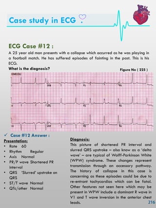 Case study in ECG .
ECG Case #12 :
A 25 year old man presents with a collapse which occurred as he was playing in
a football match. He has suffered episodes of fainting in the past. This is his
ECG.
What is the diagnosis?
 Case #12 Answer :
Presentation:
• Rate 60
• Rhythm Regular
• Axis Normal
• PR/P wave Shortened PR
interval
• QRS ‗Slurred‘ upstroke on
QRS
• ST/T wave Normal
• QTc/other Normal
Diagnosis:
This picture of shortened PR interval and
slurred QRS upstroke – also know as a ‗delta
wave‘ – are typical of Wolff-Parkinson White
(WPW) syndrome. These changes represent
transmission through an accessory pathway.
The history of collapse in this case is
concerning as these episodes could be due to
re-entrant tachycardias which can be fatal.
Other features not seen here which may be
present in WPW include a dominant R wave in
V1 and T wave inversion in the anterior chest
leads.
Figure No ( 225 )
 