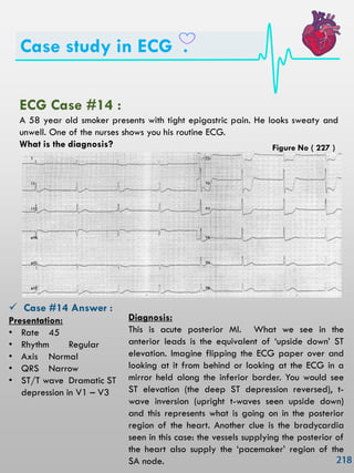 Case study in ECG .
ECG Case #14 :
A 58 year old smoker presents with tight epigastric pain. He looks sweaty and
unwell. One of the nurses shows you his routine ECG.
What is the diagnosis?
 Case #14 Answer :
Presentation:
• Rate 45
• Rhythm Regular
• Axis Normal
• QRS Narrow
• ST/T wave Dramatic ST
depression in V1 – V3
Diagnosis:
This is acute posterior MI. What we see in the
anterior leads is the equivalent of ‗upside down‘ ST
elevation. Imagine flipping the ECG paper over and
looking at it from behind or looking at the ECG in a
mirror held along the inferior border. You would see
ST elevation (the deep ST depression reversed), t-
wave inversion (upright t-waves seen upside down)
and this represents what is going on in the posterior
region of the heart. Another clue is the bradycardia
seen in this case: the vessels supplying the posterior of
the heart also supply the ‗pacemaker‘ region of the
SA node.
Figure No ( 227 )
 