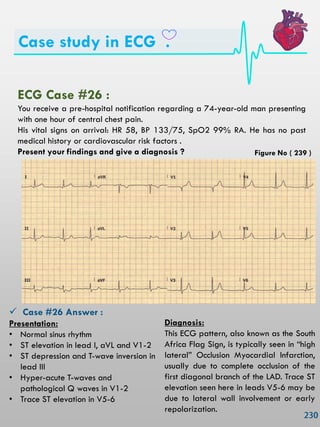 Case study in ECG .
ECG Case #26 :
You receive a pre-hospital notification regarding a 74-year-old man presenting
with one hour of central chest pain.
His vital signs on arrival: HR 58, BP 133/75, SpO2 99% RA. He has no past
medical history or cardiovascular risk factors .
Present your findings and give a diagnosis ?
 Case #26 Answer :
Presentation:
• Normal sinus rhythm
• ST elevation in lead I, aVL and V1-2
• ST depression and T-wave inversion in
lead III
• Hyper-acute T-waves and
pathological Q waves in V1-2
• Trace ST elevation in V5-6
Diagnosis:
This ECG pattern, also known as the South
Africa Flag Sign, is typically seen in ―high
lateral‖ Occlusion Myocardial Infarction,
usually due to complete occlusion of the
first diagonal branch of the LAD. Trace ST
elevation seen here in leads V5-6 may be
due to lateral wall involvement or early
repolarization.
Figure No ( 239 )
 