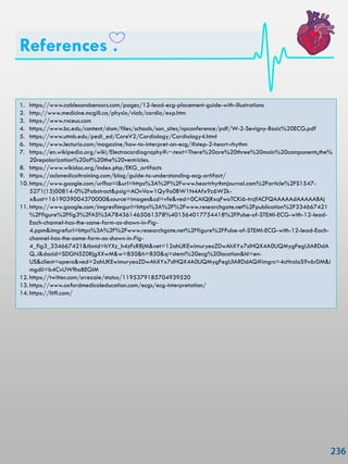 References .
1. https://www.cablesandsensors.com/pages/12-lead-ecg-placement-guide-with-illustrations
2. http://www.medicine.mcgill.ca/physio/vlab/cardio/exp.htm
3. https://www.rnceus.com
4. https://www.bc.edu/content/dam/files/schools/son_sites/npconference/pdf/W-2-Sevigny-Basic%20ECG.pdf
5. https://www.utmb.edu/pedi_ed/CoreV2/Cardiology/Cardiology4.html
6. https://www.lecturio.com/magazine/how-to-interpret-an-ecg/#step-2-heart-rhythm
7. https://en.wikipedia.org/wiki/Electrocardiography#:~:text=There%20are%20three%20main%20components,the%
20repolarization%20of%20the%20ventricles.
8. https://www.wikidoc.org/index.php/EKG_artifacts
9. https://aclsmedicaltraining.com/blog/guide-to-understanding-ecg-artifact/
10. https://www.google.com/url?sa=i&url=https%3A%2F%2Fwww.heartrhythmjournal.com%2Farticle%2FS1547-
5271(15)00814-0%2Fabstract&psig=AOvVaw1Qy9o0BW1N4Afx9z6WZk-
x&ust=1619039004370000&source=images&cd=vfe&ved=0CAIQjRxqFwoTCKi6-trcjfACFQAAAAAdAAAAABAj
11. https://www.google.com/imgres?imgurl=https%3A%2F%2Fwww.researchgate.net%2Fpublication%2F334667421
%2Ffigure%2Ffig3%2FAS%3A784361465061378%401564017754418%2FPulse-of-STEMI-ECG-with-12-lead-
Each-channel-has-the-same-form-as-shown-in-Fig-
4.ppm&imgrefurl=https%3A%2F%2Fwww.researchgate.net%2Ffigure%2FPulse-of-STEMI-ECG-with-12-lead-Each-
channel-has-the-same-form-as-shown-in-Fig-
4_fig3_334667421&tbnid=hYXz_h4zFcR8jM&vet=12ahUKEwimuryeoZDwAhXYx7sIHQX4A0UQMygFegUIARDdA
Q..i&docid=SDGN5Z0RjgXXwM&w=850&h=850&q=stemi%20ecg%20location&hl=en-
US&client=opera&ved=2ahUKEwimuryeoZDwAhXYx7sIHQX4A0UQMygFegUIARDdAQ#imgrc=4cHrolaS9v6rDM&i
mgdii=b4CvUWfhoBEGIM
12. https://twitter.com/srrezaie/status/1195379185704939520
13. https://www.oxfordmedicaleducation.com/ecgs/ecg-interpretation/
14. https://litfl.com/
 