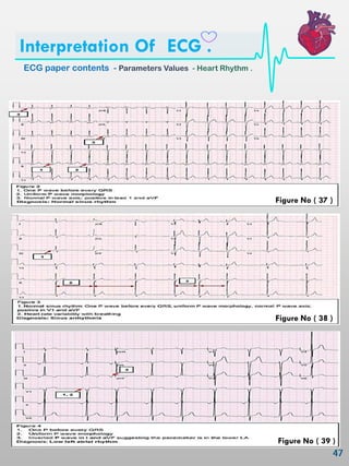 Ecg Interpretation Chart.pdf Ecg interpretation | PDF