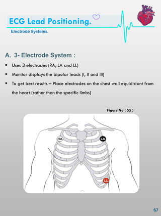 A. 3- Electrode System :
 Uses 3 electrodes (RA, LA and LL)
 Monitor displays the bipolar leads (I, II and III)
 To get best results – Place electrodes on the chest wall equidistant from
the heart (rather than the specific limbs)
Electrode Systems.
ECG Lead Positioning.
Figure No ( 55 )
 