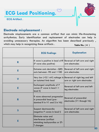 Electrode misplacement :
Electrode misplacements are a common artifact that can mimic life-threatening
arrhythmias. Early identification and replacement of electrodes can help in
avoiding unnecessary therapies. An algorithm has been described previously ,
which may help in recognizing these artifacts .
ECG findings Explanation
R
R wave is positive in lead aVR
(P wave also positive)
Reversal of left arm and right
arm electrodes
E
Extreme axis deviation : QRS
axis between -90 and +180
Reversal of left arm and right
arm electrodes
V
Very low (<0.1 mV) voltage in
an isolated limb lead
Reversal of right leg and left
arm or right arm electrodes
E
Exchanged amplitude of P
waves (P wave in lead I >
lead II)
Reversal of left arm and left
leg electrodes
R
R wave abnormal progression
in precordial lead (pre-
dominal R in V1 and S in V6)
Reversal of precordial
electrodes (V1 through V6)
S
Suspect dextrocardia
(negative P waves in lead I)
Reversal of left arm and right
arm electrodes
E
Eliminate noise and
interference (artifact
mimicking tachycardias or ST-
T changes
ECG Artifact .
ECG Lead Positioning.
Table No. ( 4 )
 
