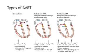 Ecg interpretation , Upgraded | PPTX