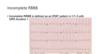 Ecg interpretation , Upgraded | PPTX
