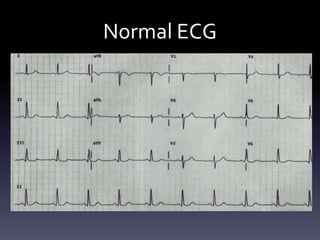Normal ECG
 