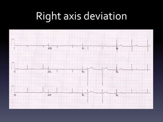 Right axis deviation
 