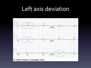 Left axis deviation
 