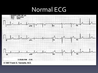 Normal ECG
 
